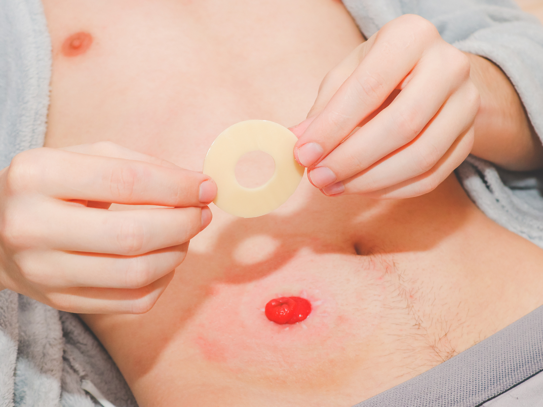 How Often Should You Change Your Ostomy Bag?
