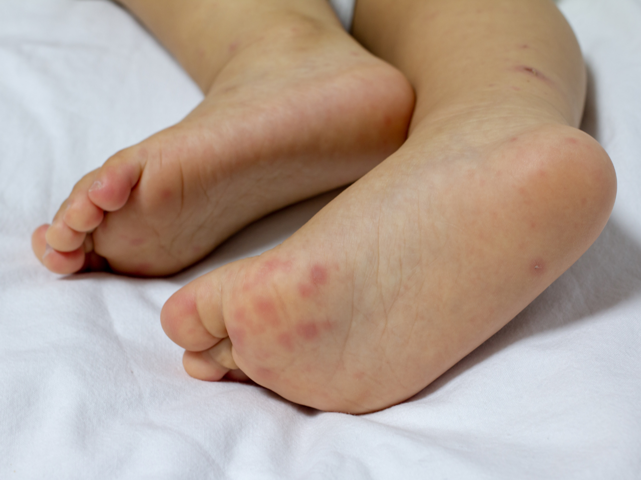 Hand foot mouth disease - affected feet