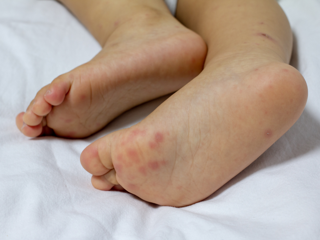 Hand Foot Mouth Disease (HFMD) Getting A Foothold On The Nation?